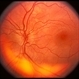 Disc Drusen and Anomolous Veins Disc Drusen and Anomolous Veins