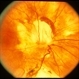 Inferior Choroidal Coloboma and Tilted Disc Inferior Choroidal Coloboma and Tilted Disc