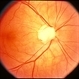 Probable Optic Nerve Coloboma Probable Optic Nerve Coloboma