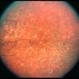 Congenital Nyctalopia