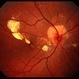 Astrocytoma Astrocytoma