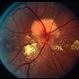 Astrocytoma Astrocytoma
