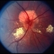 Astrocytoma Astrocytoma