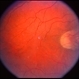 Optic Nerve Malformation Optic Nerve Malformation