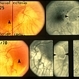 Optic Nerve Malformation Optic Nerve Malformation