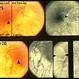 Optic Nerve Malformation Optic Nerve Malformation
