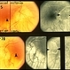 Optic Nerve Malformation Optic Nerve Malformation