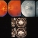 Optic Nerve Malformation Optic Nerve Malformation