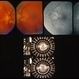 Optic Nerve Malformation Optic Nerve Malformation