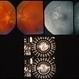 Optic Nerve Malformation Optic Nerve Malformation