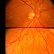 Optic Nerve Malformation Optic Nerve Malformation