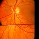 Optic Nerve Malformation Optic Nerve Malformation