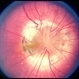 Optic Nerve Malformation/Coloboma/ Bergmeister's Papilla Optic Nerve Malformation/Coloboma/ Bergmeister's Papilla
