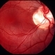 Optic Nerve Pit Optic Nerve Pit