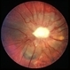 Optic Nerve Malformation/Possible Combined Hamartoma of Retinal Pigment Epithelium Optic Nerve Malformation/Possible Combined Hamartoma of Retinal Pigment Epithelium
