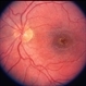 Macular Exudates Macular Exudates