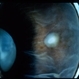 peripheral uveitis peripheral uveitis