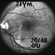 Recurrent Pseudotumor with Scleritis Recurrent Pseudotumor with Scleritis