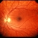 Ocular Albinism Carrier Ocular Albinism Carrier