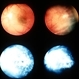 pars planitis; macular cysts and serous detachment pars planitis; macular cysts and serous detachment