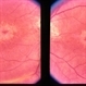 Benign Concentric Macular Annular Dystrophy Benign Concentric Macular Annular Dystrophy