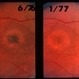 Pattern Dystrophy Pattern Dystrophy