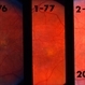 Pattern Dystrophy Pattern Dystrophy