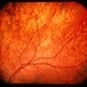 Ocular Albinism Carrier Ocular Albinism Carrier