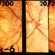 Ocular albinism Ocular albinism