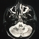 Mass on MRI Mass on MRI