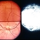 Foveal Hypoplasia Foveal Hypoplasia