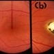 Macular Coloboma Macular Coloboma