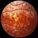 Rubella Retinopathy Rubella Retinopathy