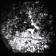 Rubella Retinopathy Rubella Retinopathy