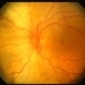 Metastatic Breast Cancer Metastatic Breast Cancer