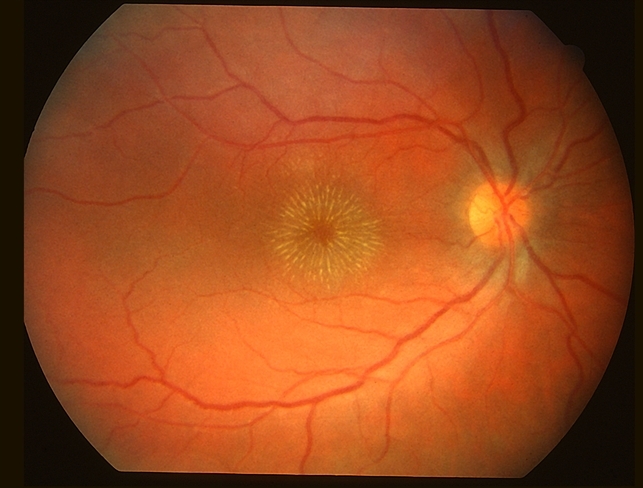 Macular Star - Retina Image Bank
