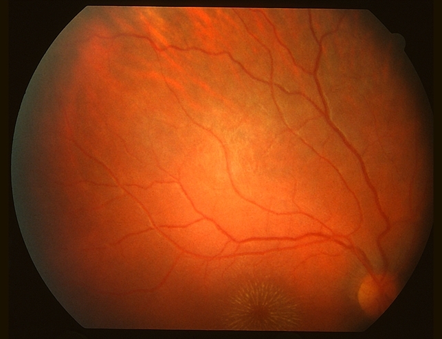 Macular Star Superior Field - Retina Image Bank