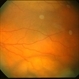 Choroidal Tumor, Breast Cancer Choroidal Tumor, Breast Cancer