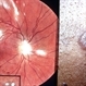 Sarcoid Sarcoidosis Sarcoid Sarcoidosis