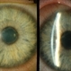 pupillary block; periph uveitis pupillary block; periph uveitis