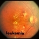 Leukemia Leukemia