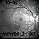 red-free photo showing multifocal choroiditis red-free photo showing multifocal choroiditis