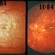 multifocal choroiditis multifocal choroiditis