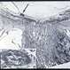 hemorrhagic necrosis hemorrhagic necrosis