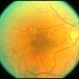 Macular Pucker