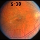 Fundus 2 weeks after treatment Fundus 2 weeks after treatment
