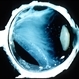 vitreous exudate vitreous exudate