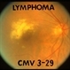 Lymphoma Acute Retinal Necrosis (ARN) Lymphoma Acute Retinal Necrosis (ARN)