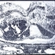 Hemorrhagic Necrosis Hemorrhagic Necrosis