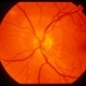 Enlarged Blind Spot Enlarged Blind Spot